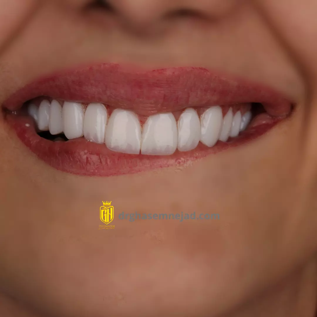 کامپوزیت دندان با لبه شیشه ای و شفاف