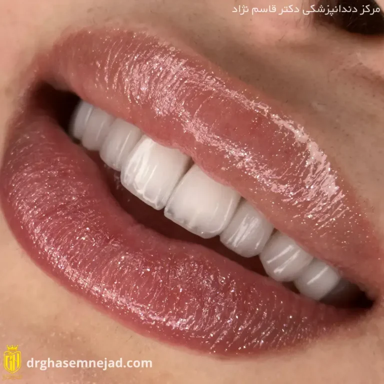 لمينت دندان