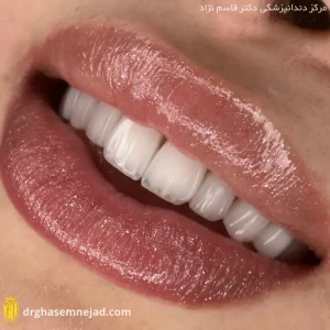 نمونه لمینت ایمکس دندان