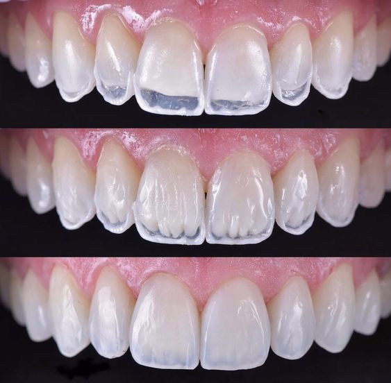 کامپوزیت دندان لبه شفاف
