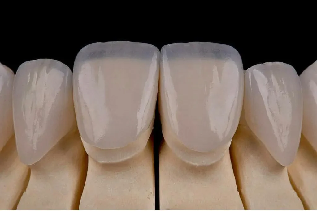 لمینت دندان لبه شیشه ای و شفاف