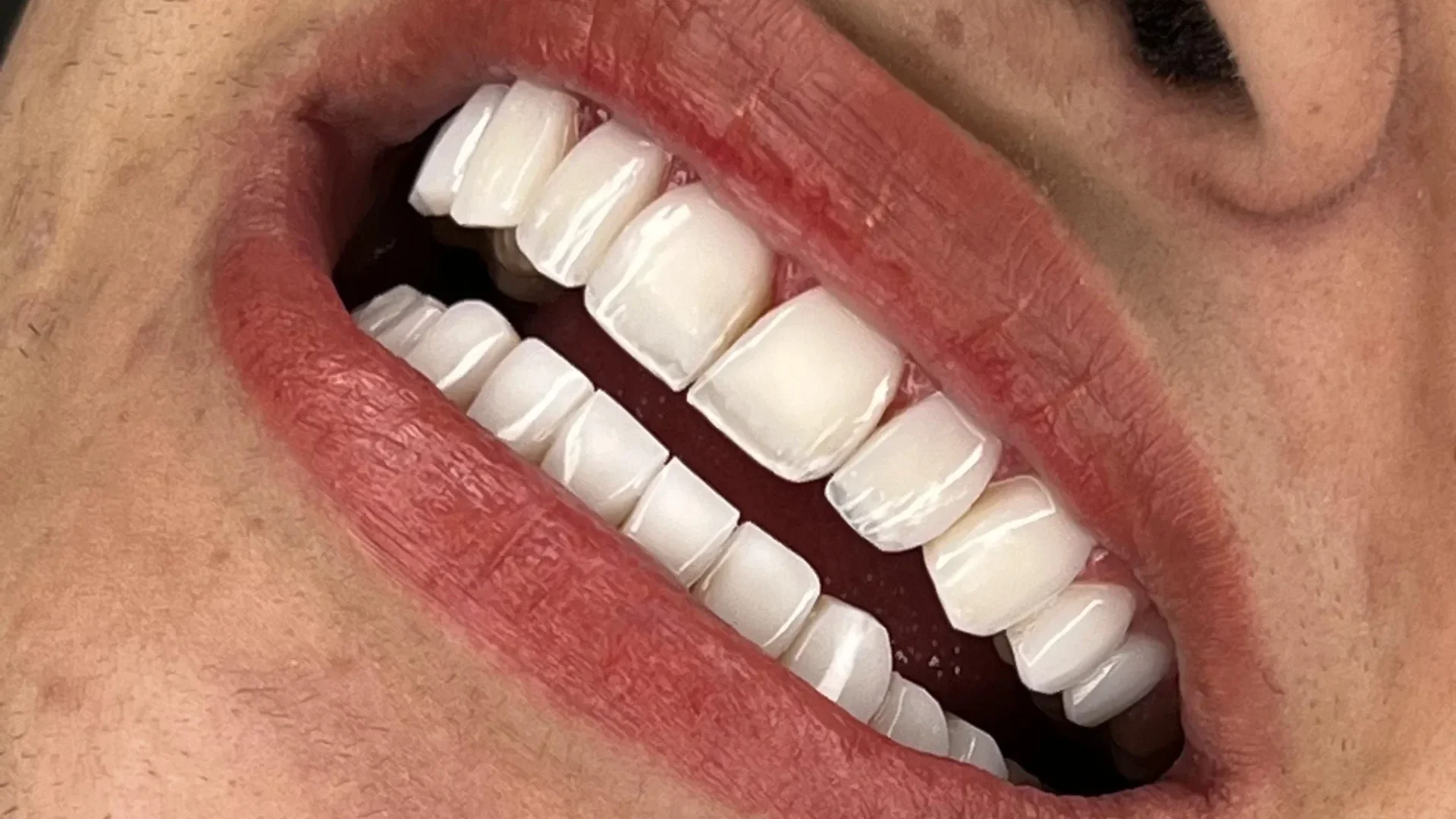 کامپوزیت لب شیشه ای دندان