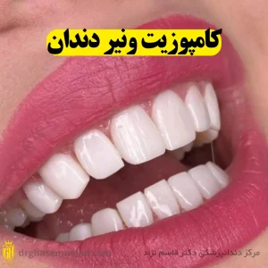 کامپوزیت ونیر دندان