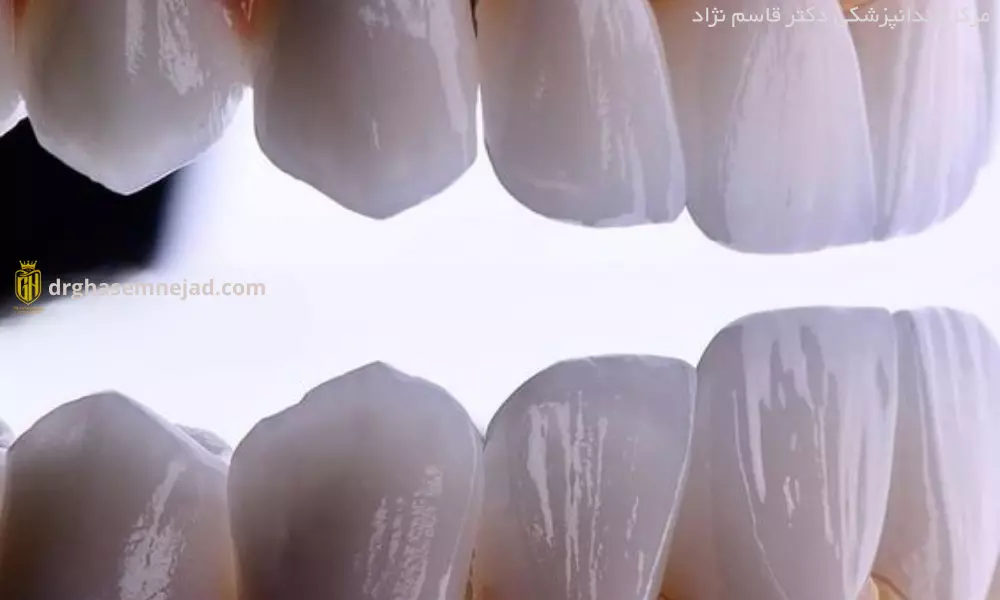 لمینت دندان لبه شیشه ای