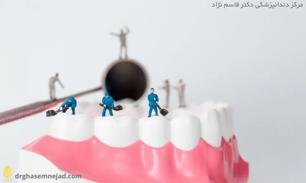 پوسیدگی دندان