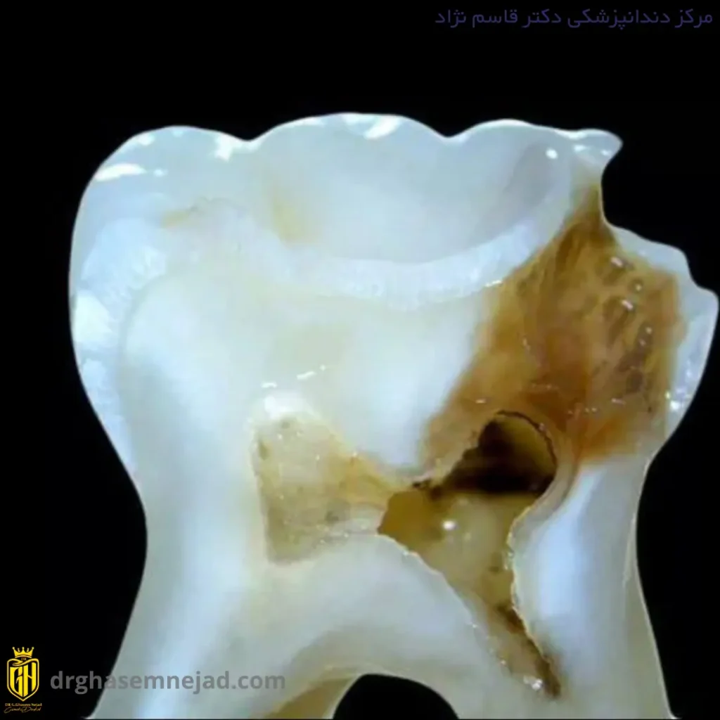 پوسیدگی دندان
