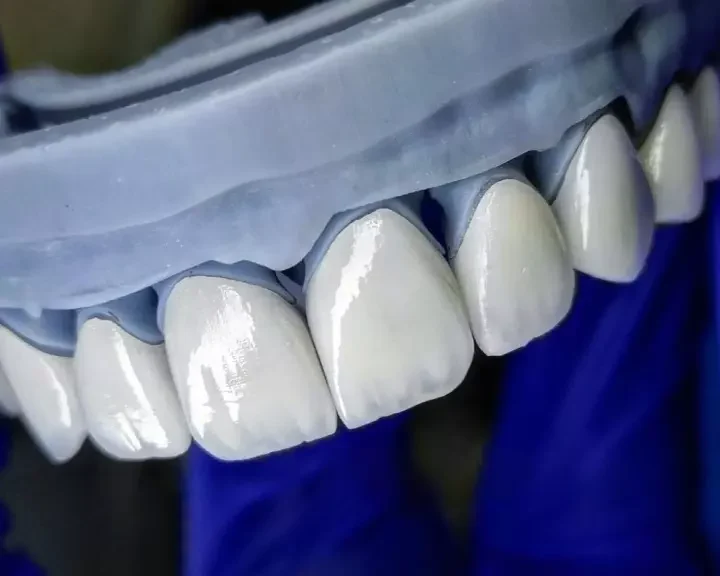 روش لیرینگ دندان