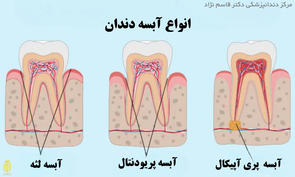 انواع آبسه دندان لثه
