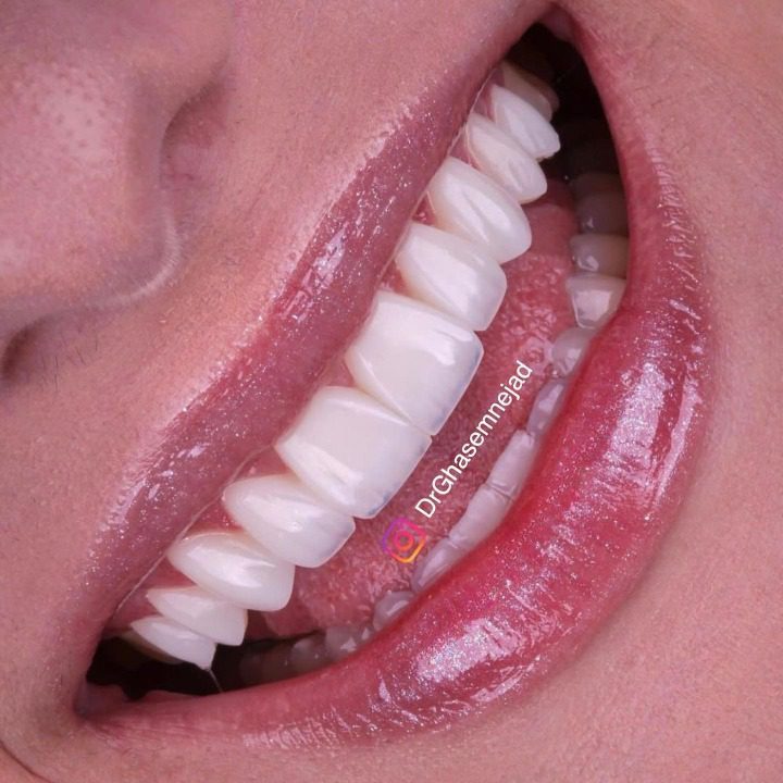  کامپوزیت دندان
