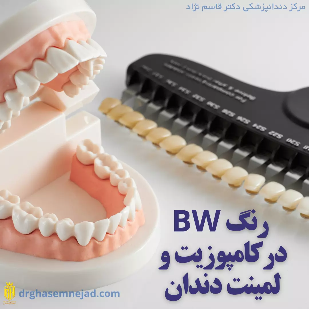 رنگ BW کامپوزیت و لمینت دندان
