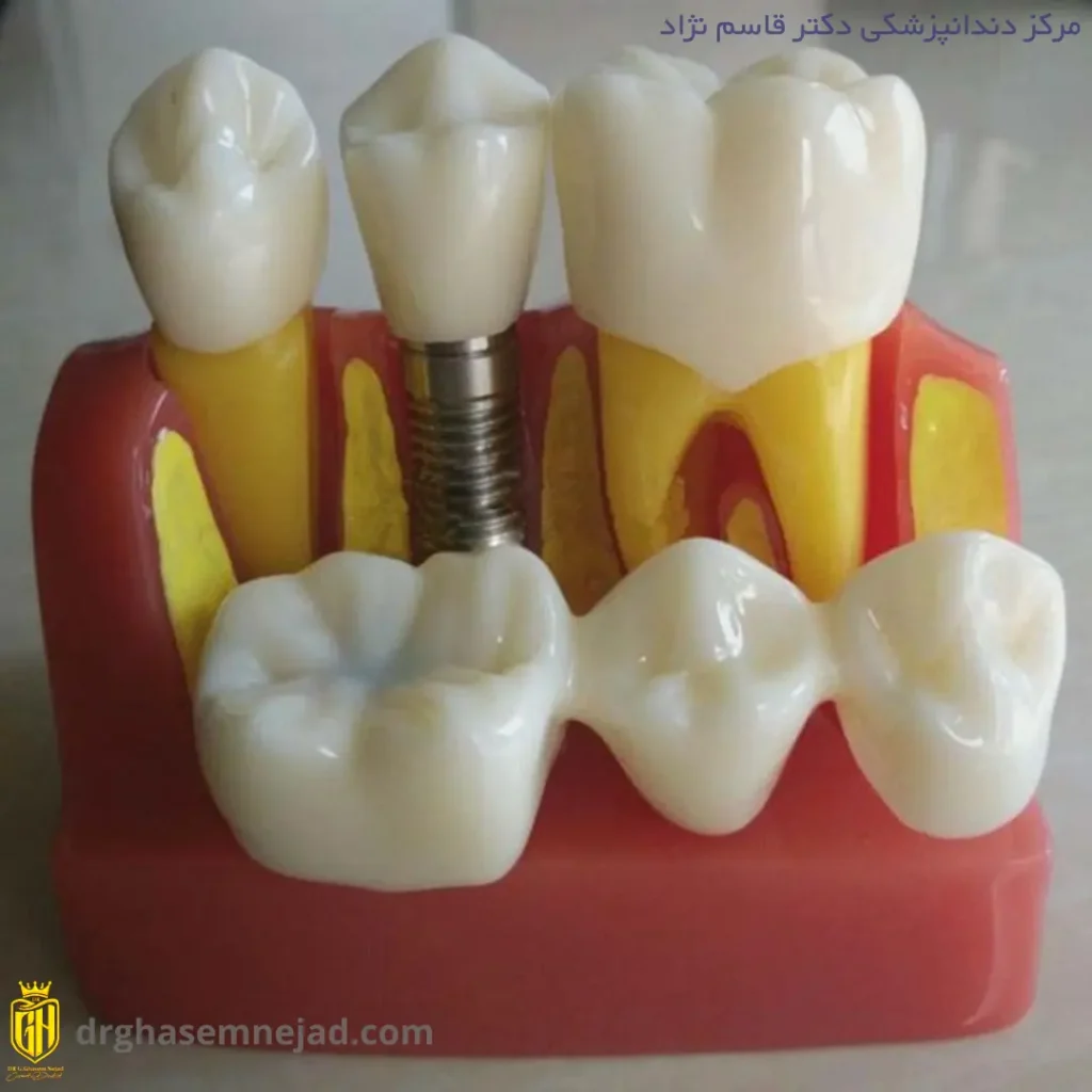 مقایسه بریج دندان و ایمپلنت