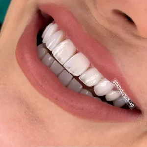 تخفیف کامپوزیت دندان