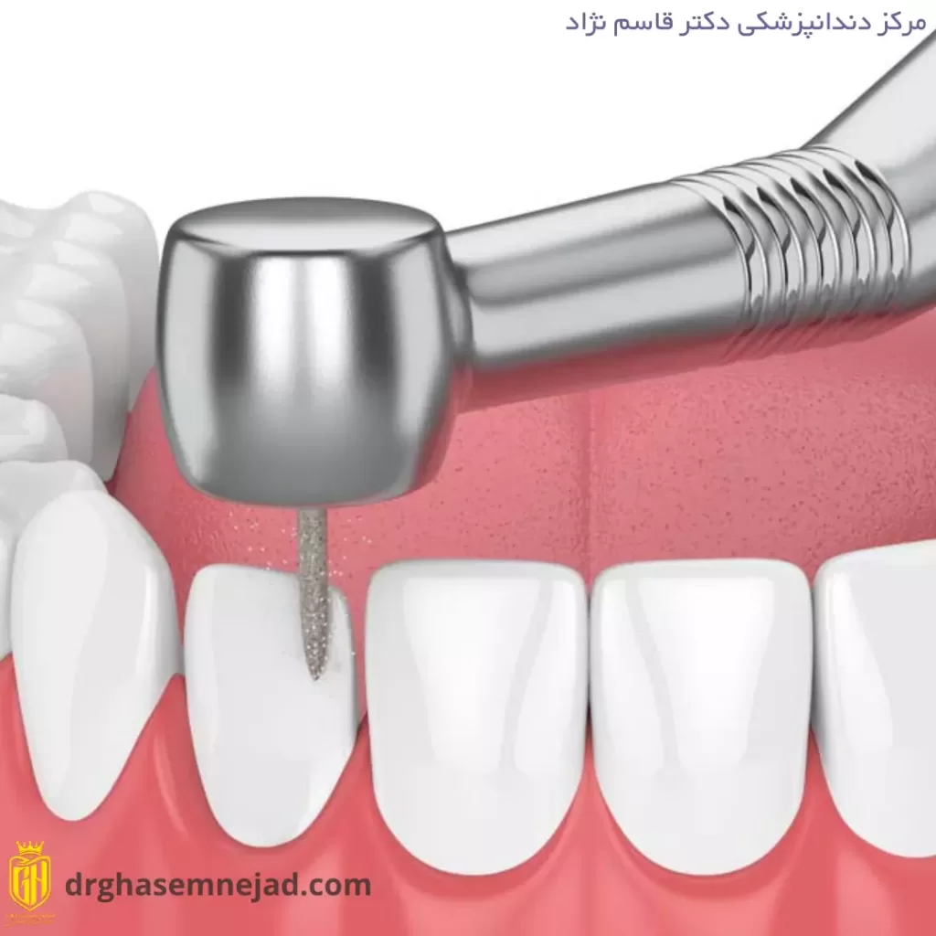 تراش برای لمینت دندان