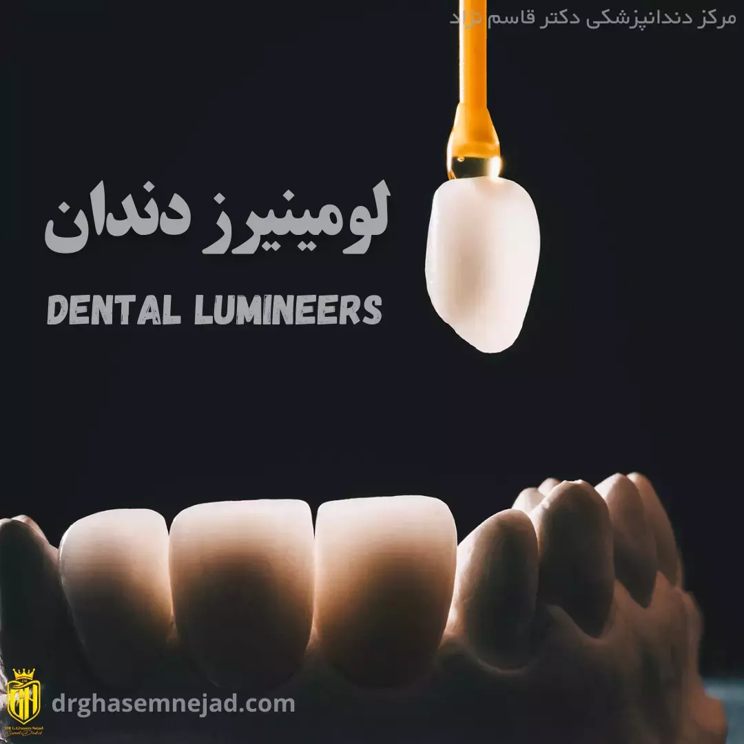 لومینیرز دندان Dental lumineers