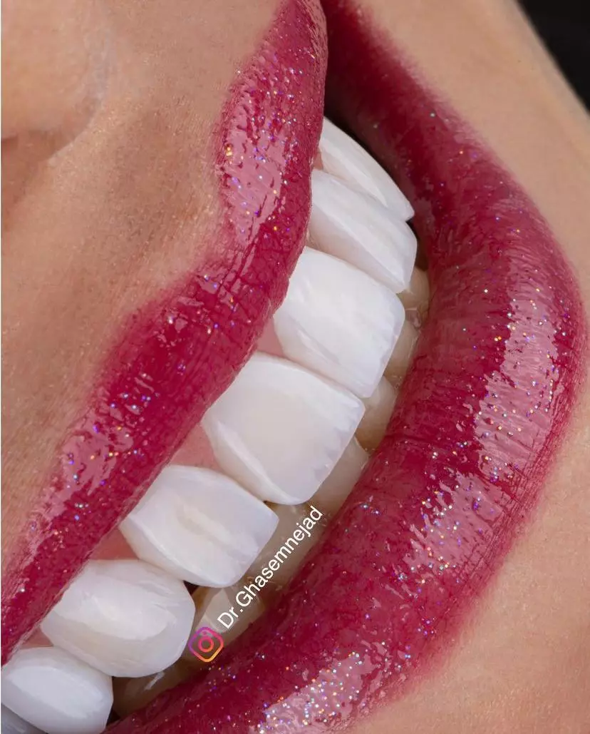 کامپوزیت دندان سارمکو