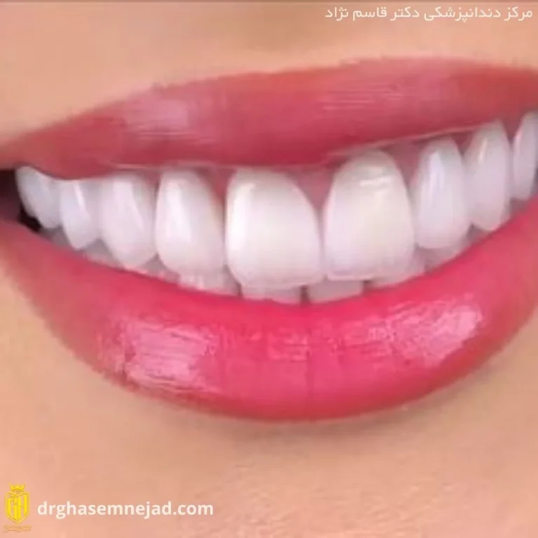  کامپوزیت دندان (1)