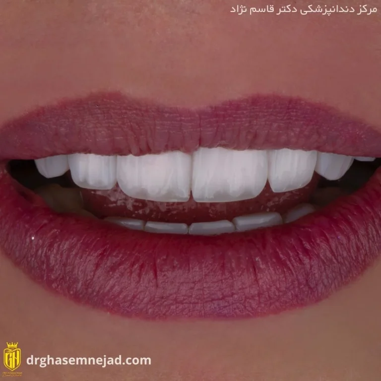  کامپوزیت دندان (10)