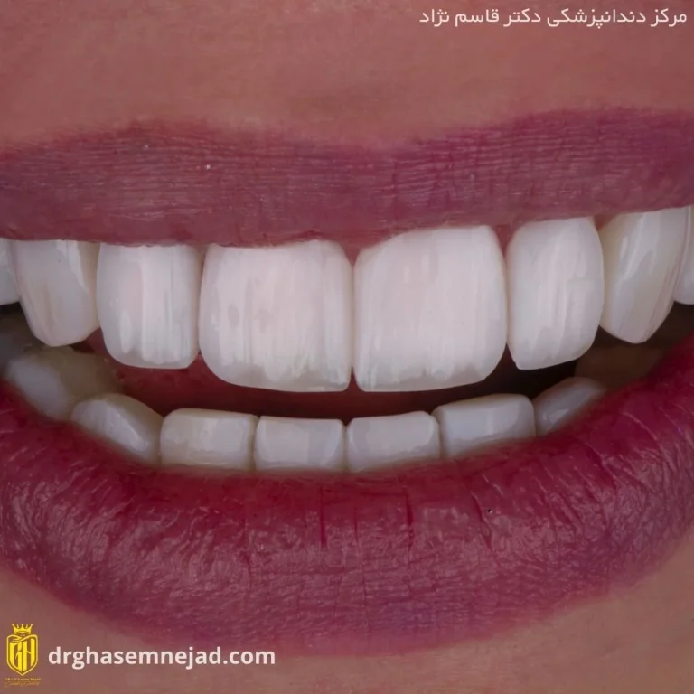  کامپوزیت دندان (11)