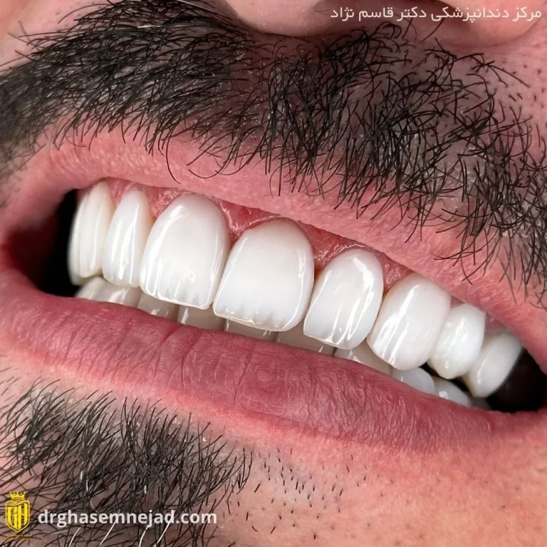  کامپوزیت دندان (12)