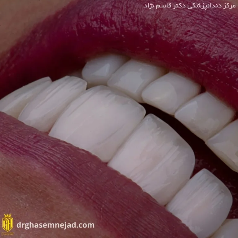  کامپوزیت دندان (14)