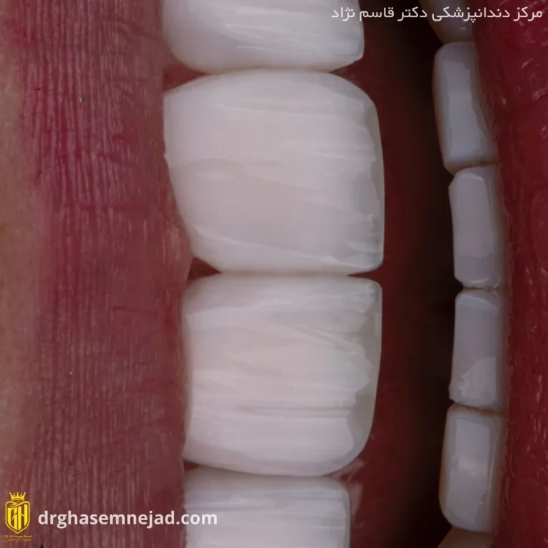  کامپوزیت دندان (15)