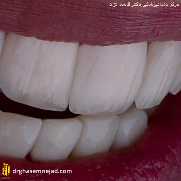  کامپوزیت دندان (16)