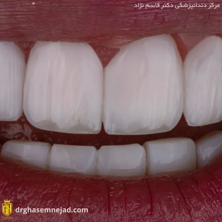  کامپوزیت دندان (18)