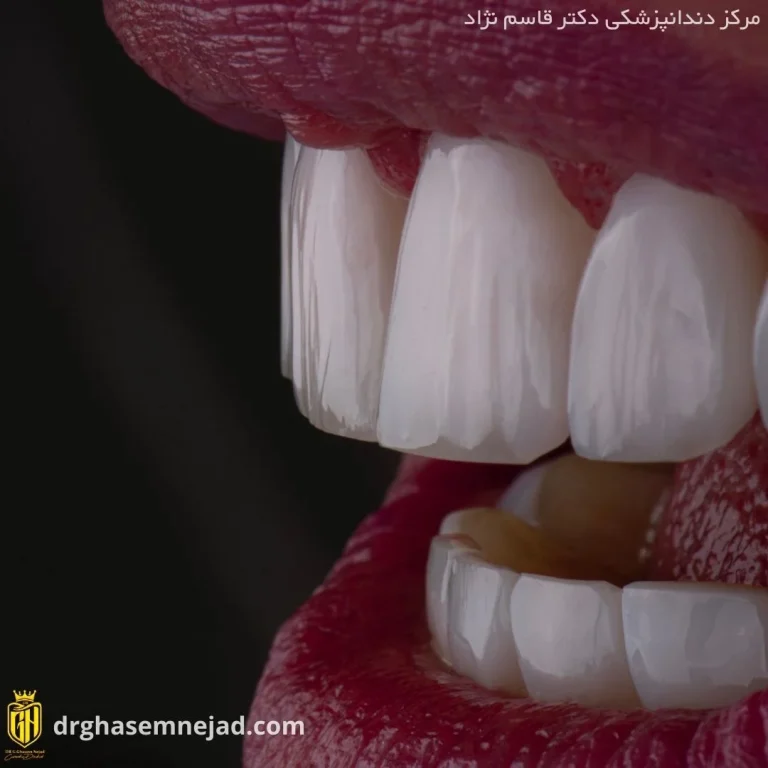  کامپوزیت دندان (19)