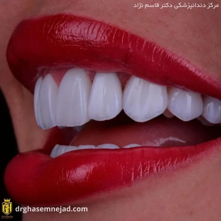  کامپوزیت دندان (2)