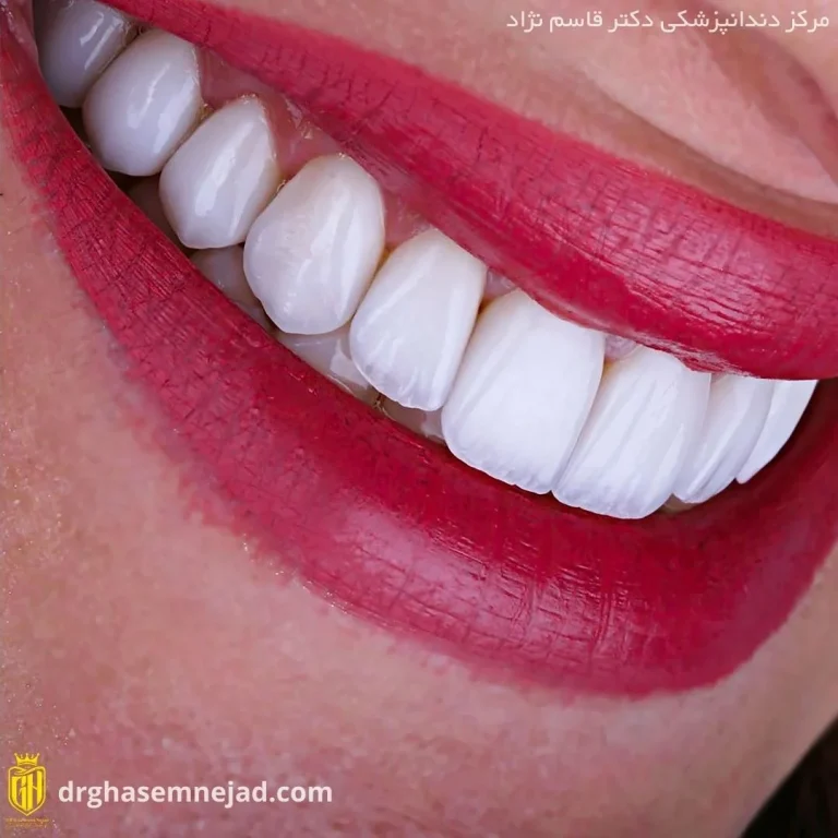  کامپوزیت دندان (20)