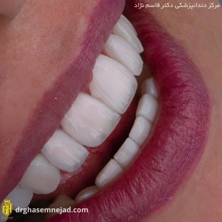  کامپوزیت دندان (5)