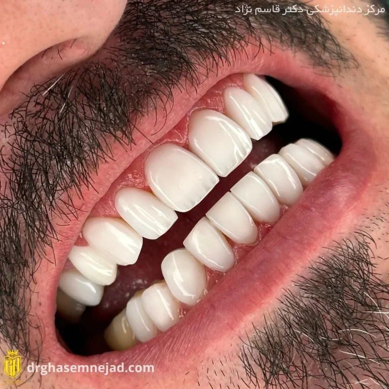  کامپوزیت دندان (6)