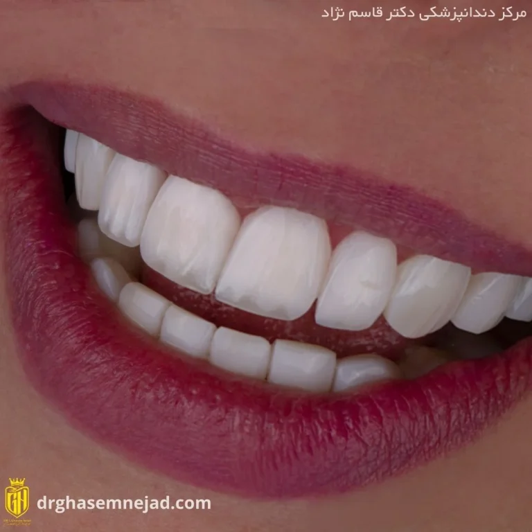  کامپوزیت دندان (7)