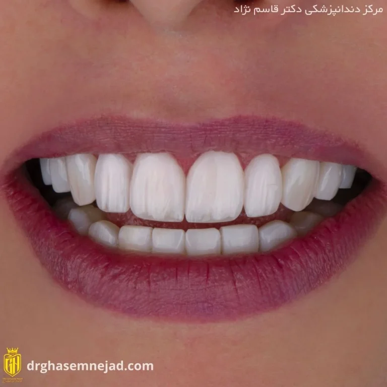  کامپوزیت دندان (8)