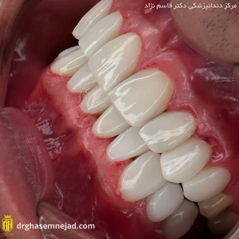 کامپوزیت دندان (9)