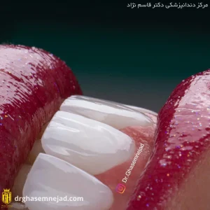 نمونه کار لمینت دندان