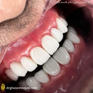 نمونه عکس لمینت دندان