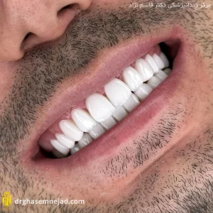 لمینت دندان (8)