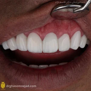 آیا کامپوزیت باعث پوسیدگی دندان میشود