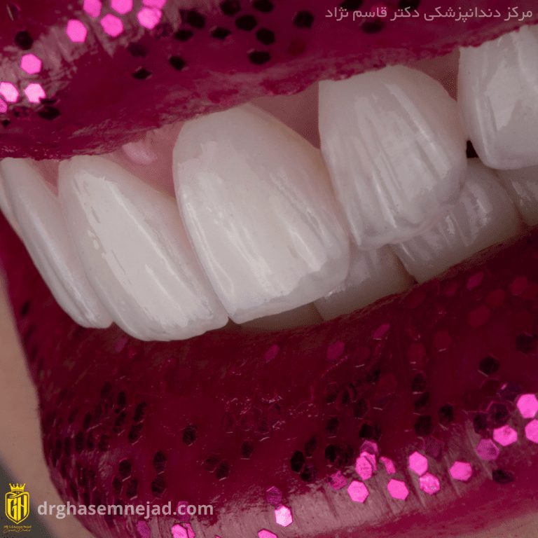  لمینت دندان (2)