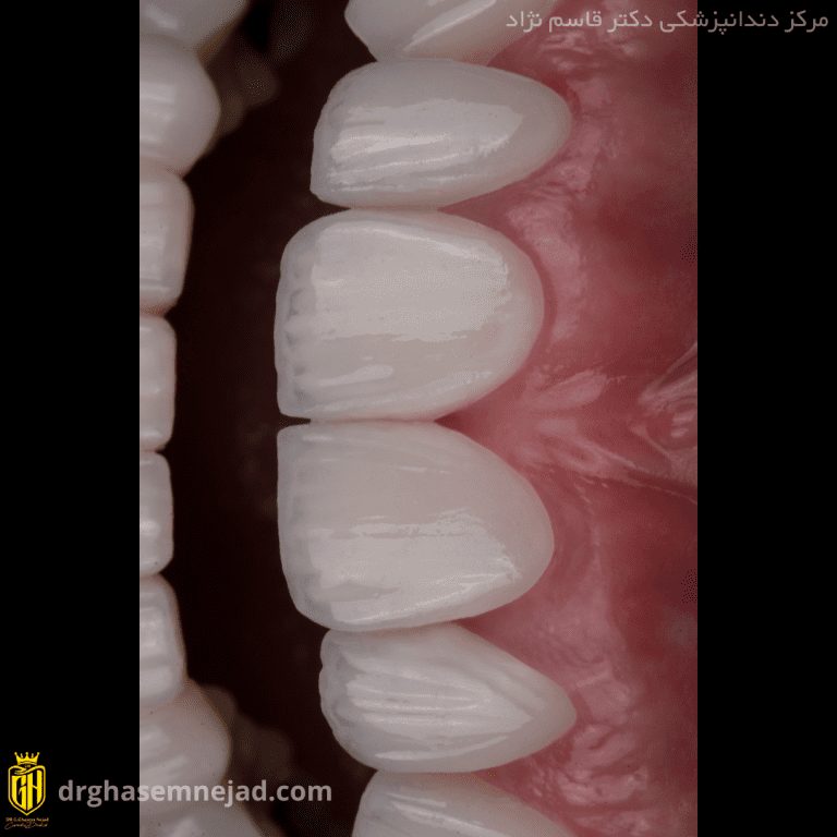  لمینت دندان (5)