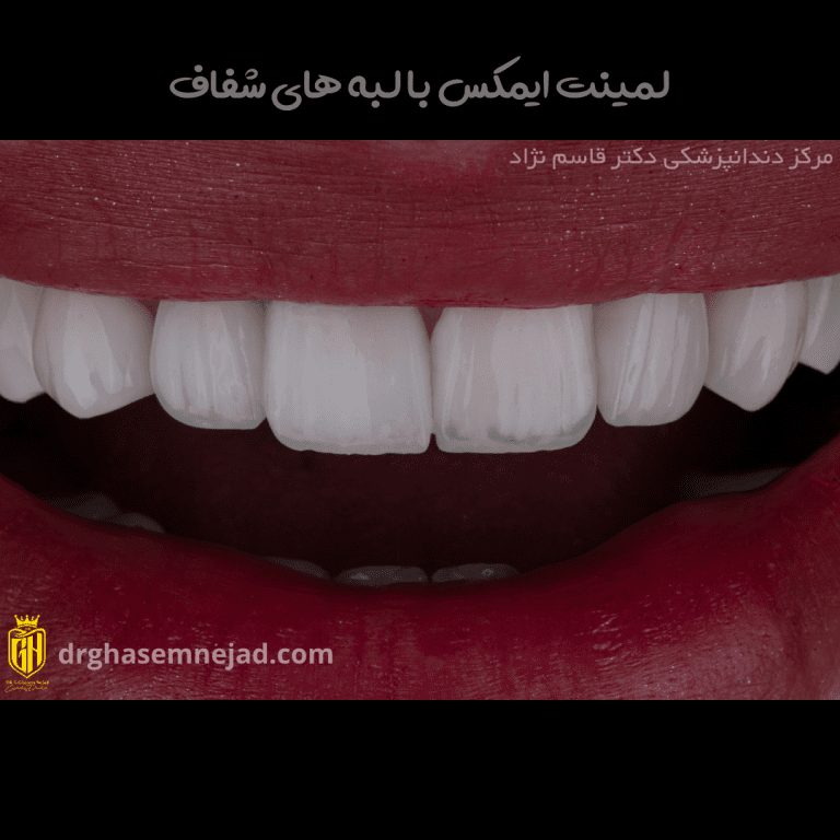  لمینت دندان تهران (11)