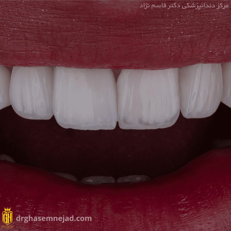  دندان لبه شفاف (47)