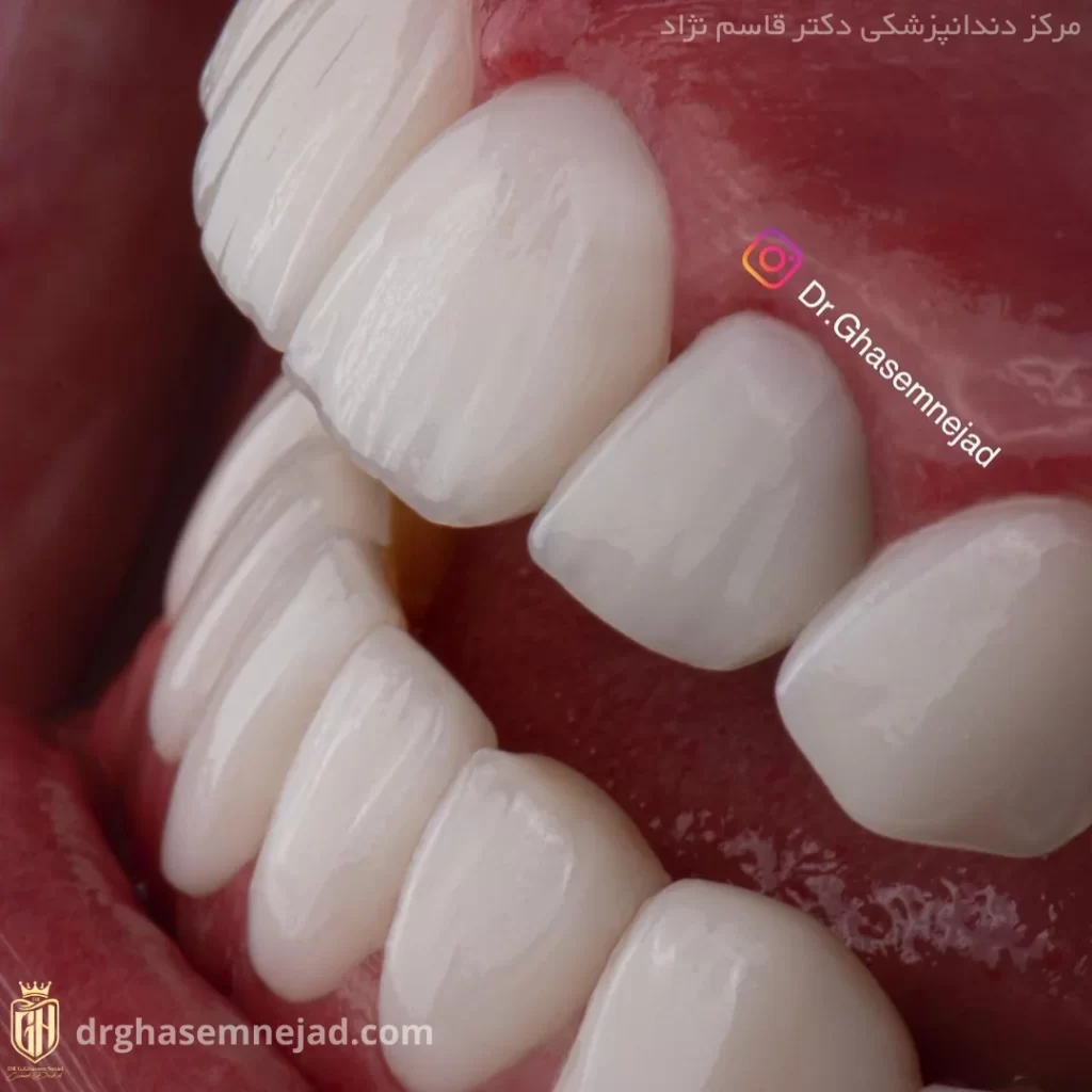عوارض تراش زیاد لمینت دندان