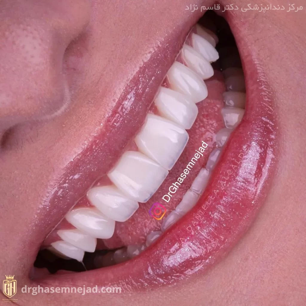 لمینت دندان مناسب چه کسانی است؟
