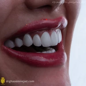 نمونه لمینت دندان ایمکس و قیمت لمینت دندان