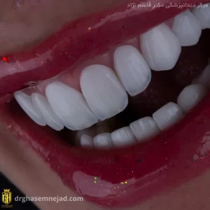 نمونه لمینت دندان ایمکس و قیمت لمینت دندان