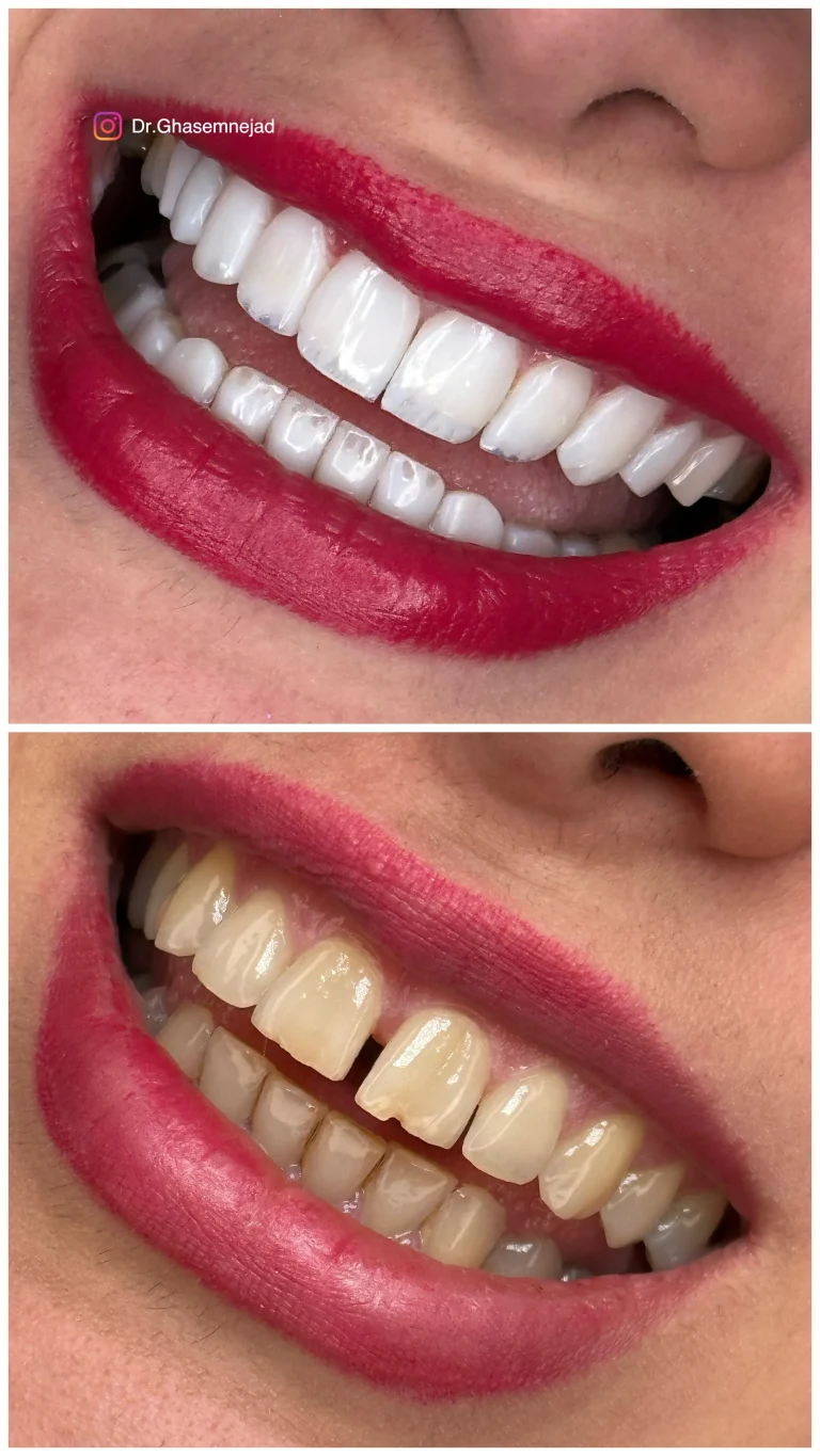  سرامیک دندان قبل و بعد