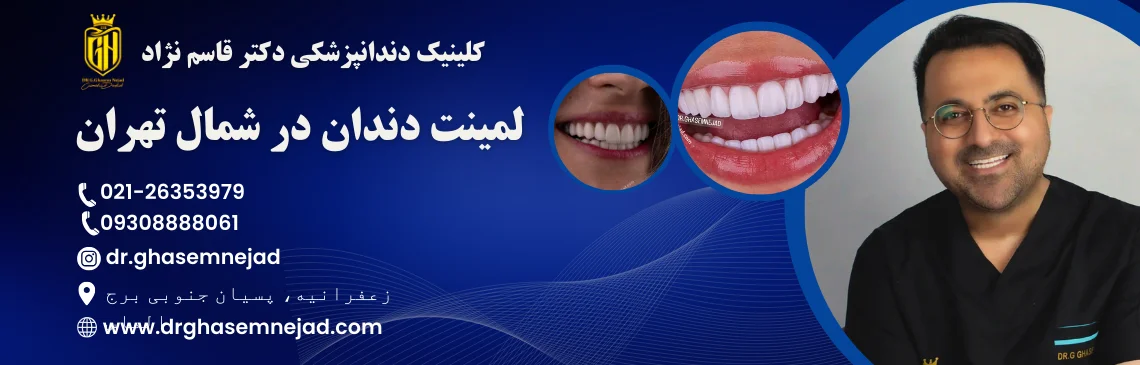 لمینت دندان شمال تهران