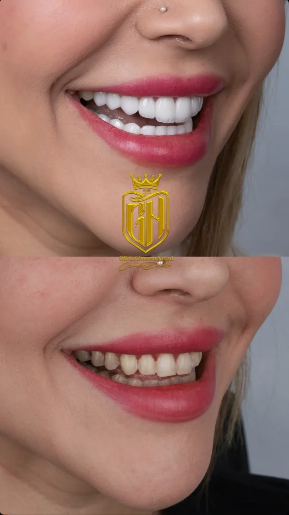 لمینت دندان ویژه vip وی آی پی 2